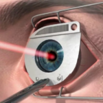 Как проходит лазерная коррекция зрения?